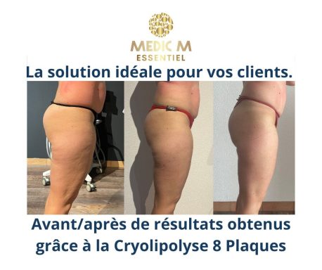 Résultats avant et après traitement des cuisses de profil avec la Cryolipolyse 8 Plaques, réduction visible des amas graisseux.