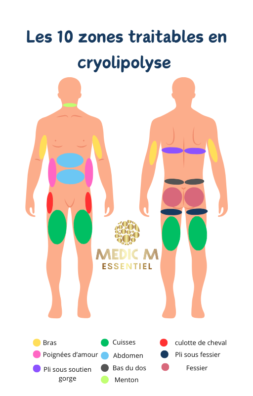 Schéma des zones principales traitées en cryolipolyse par aspiration et par plaques.