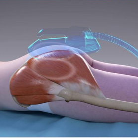 image montrant l'action de L'EMS sur le muscle lors d'une séance