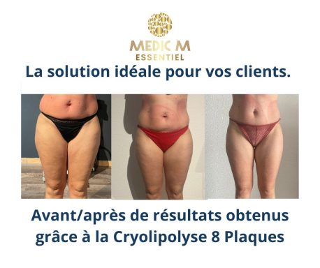 Résultats avant et après traitement des cuisses de face avec la Cryolipolyse 8 Plaques, contour amélioré et peau raffermie.