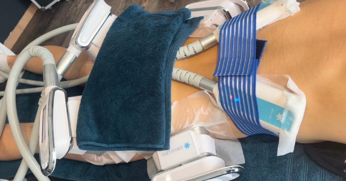 Cliente Cryo M, lors d'une séance cryolipolyse vacuum poignéd'amour et pli sous fessier ainsi que cryolipolyse plaques plis du dos