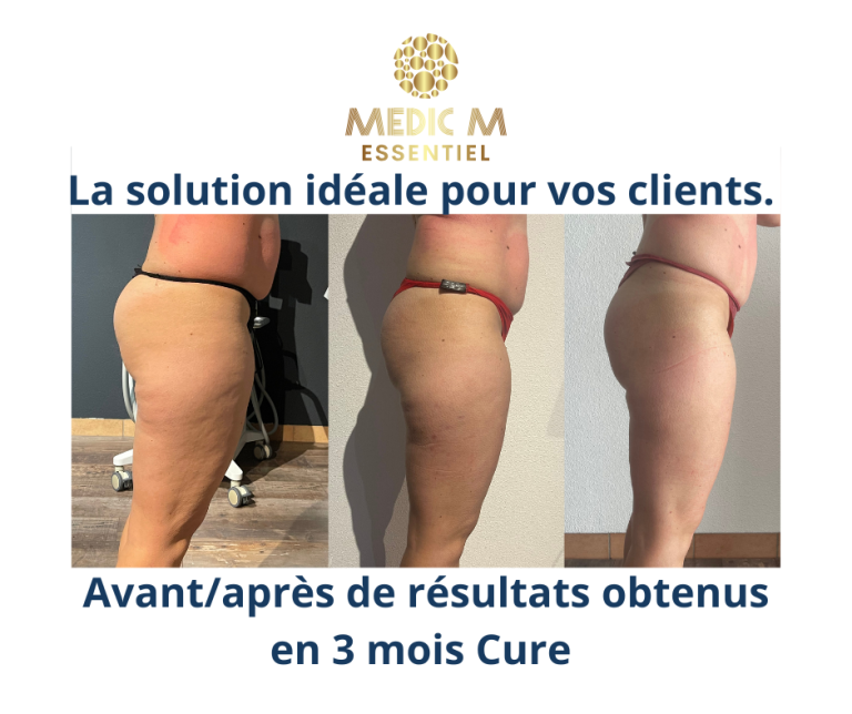 Avant-après d'une cliente Cryo M, appareils utilisé Body Shape, cryolipolyse vacuum et 8 plaques, Ems body sculpt 15 tesla