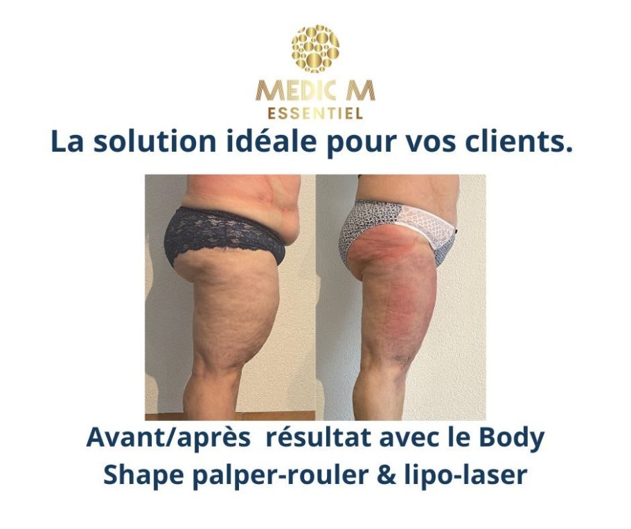 Photo démontrant l'efficacité du Body Shape palper rouler zone cuisses, résultat époustouflant chez Cryo M bien-être & amincissement Le Mans